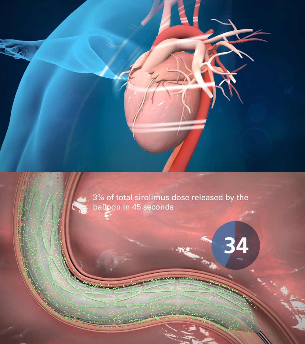 destiny_stent_slider_comp_mu_studio destiny_stent_slider_comp_mu_studio